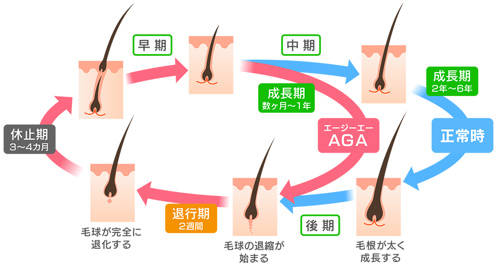 AGAは進行性なので、早めのケアが大切です。